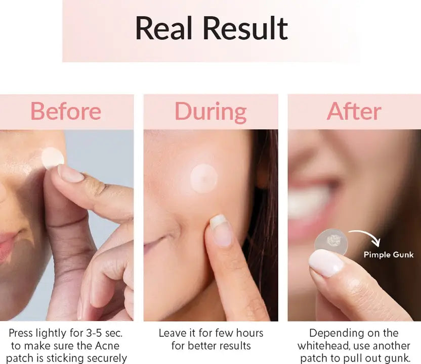 Priveda Spot Clearing Patch (Pouch) 100% Made in Korea Pimple/Acne absorbing  (57 g)